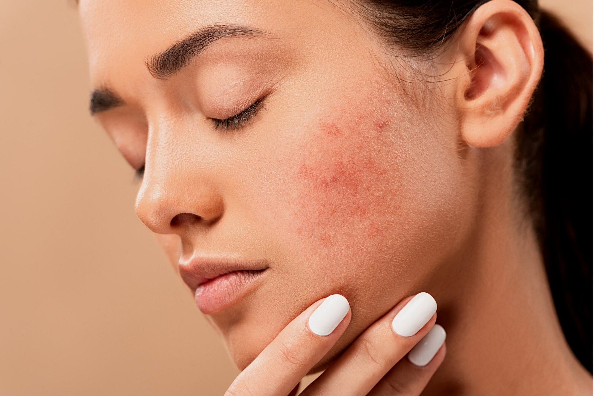 Dermatology