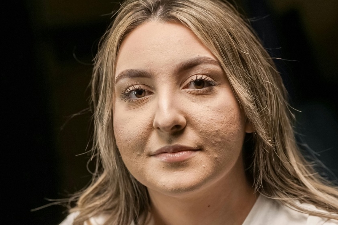 Ακμή μετά το καλοκαίρι: Τα Dos και Don’ts για να την αποφύγετε