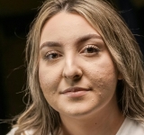 Ακμή μετά το καλοκαίρι: Τα Dos και Don’ts για να την αποφύγετε