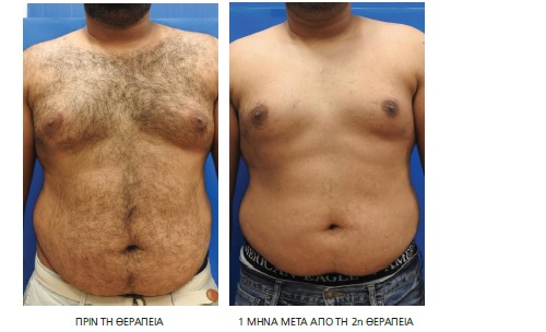 manlasertherapy